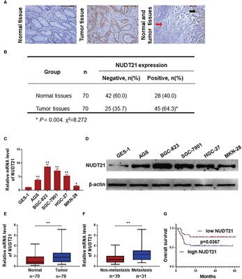 Corrigendum: NUDT21 promotes tumor growth and metastasis through modulating SGPP2 in human gastric cancer